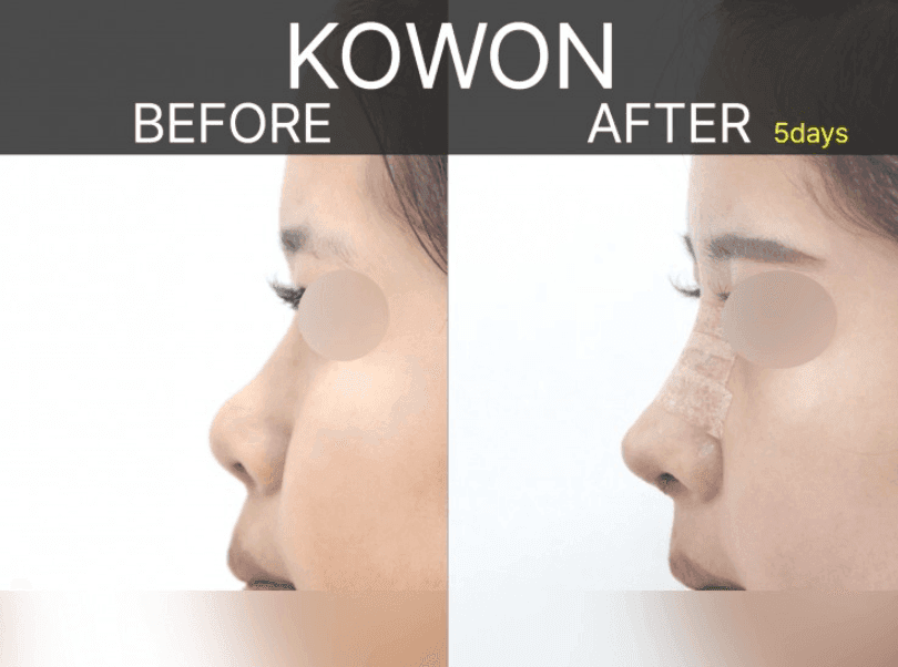 Image 7/9 for: short nose rhinoplasty before/after — change process and recovery