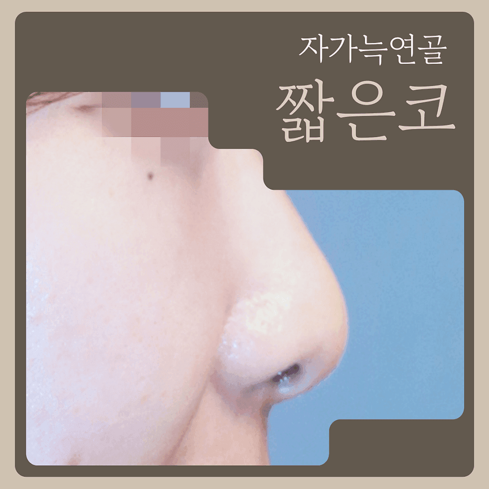짧은코성형에 자가늑연골을 고려하는 기준 — 길이·비율·지지 구조를 구분하는 순서 관련 이미지 1/7