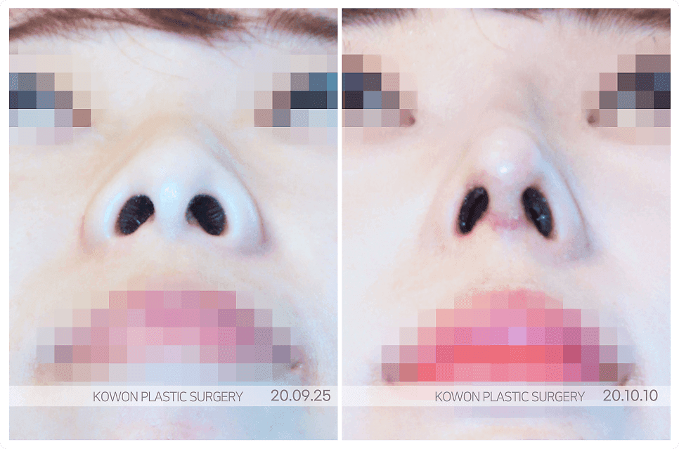 짧은코성형에 자가늑연골을 고려하는 기준 — 길이·비율·지지 구조를 구분하는 순서 관련 이미지 3/7