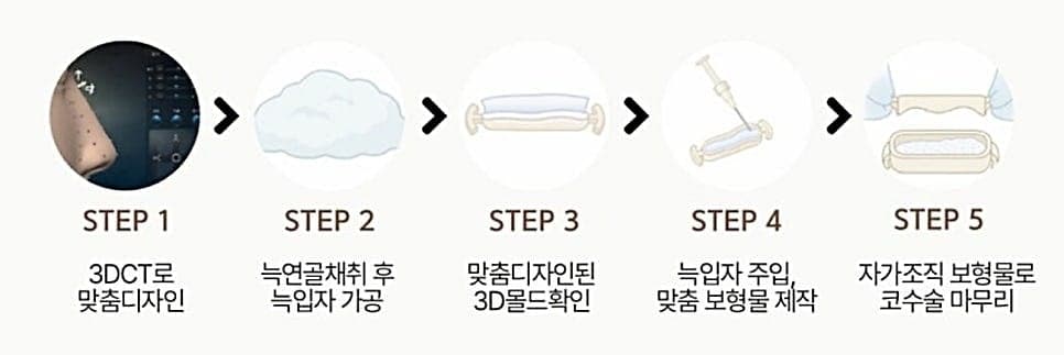 짧은코성형에 자가늑연골을 고려하는 기준 — 길이·비율·지지 구조를 구분하는 순서 관련 이미지 6/7
