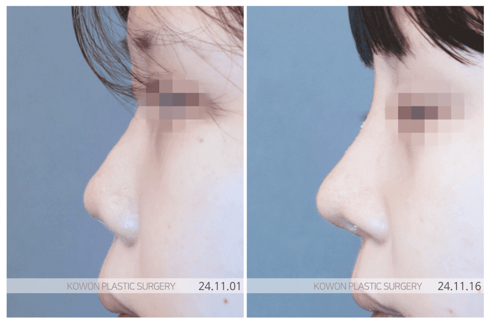 เหตุผลในการใช้กระดูกอ่อนซี่โครงของตนเองในการผ่าตัดจมูกสั้น— สาเหตุเชิงโครงสร้างที่ทำให้ปลายจมูกยกขึ้นเมื่อลดระดับเฉพาะปลายจมูกเท่านั้น ภาพที่เกี่ยวข้อง 3/6