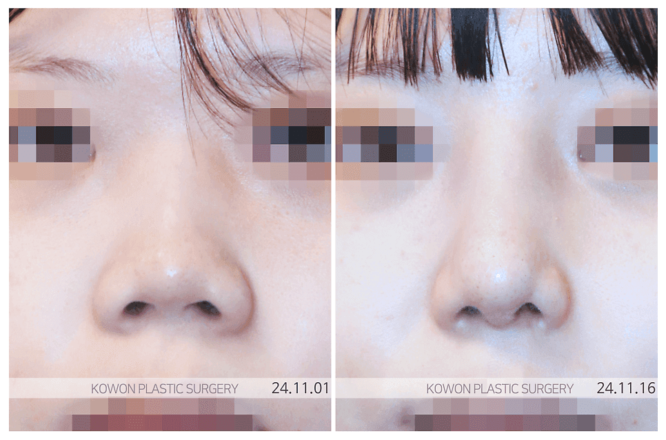 เหตุผลในการใช้กระดูกอ่อนซี่โครงของตนเองในการผ่าตัดจมูกสั้น— ภาพที่เกี่ยวข้อง 4/6 เกี่ยวกับสาเหตุเชิงโครงสร้างที่ทำให้ปลายจมูกยกสูงขึ้นอีกครั้งหลังจากลดระดับลง