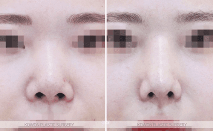 실리콘·알로덤 수술 후 코끝이 더 뭉툭해졌다면 — 재수술은 비대칭부터 봅니다 관련 이미지 3/6