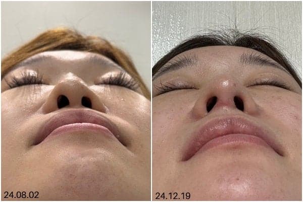 อะไรคือความแตกต่างระหว่างศัลยกรรมแก้จมูกและการใช้เนื้อเยื่อของตนเองหลังการเอาซิลิโคนออกจากจมูก? — ภาพที่เกี่ยวข้องเกี่ยวกับการจำแนกบทบาทตามวัสดุ 5/7