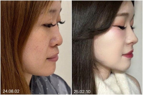 코실리콘제거 후 코재수술, 자가조직은 종류마다 무엇이 다를까 — 재료별 역할 구분 관련 이미지 7/7