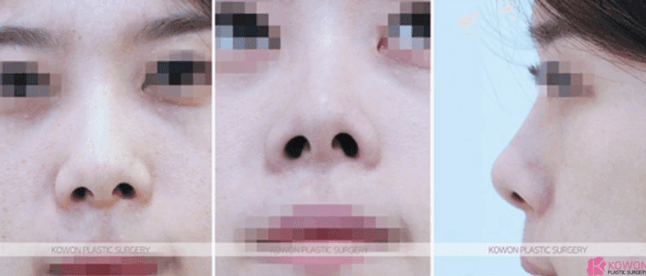 실리콘 제거하면 돼지코가 될까요? — 코 움직임이 돌아오는 시기와 기다려야 하는 이유 관련 이미지 4/10