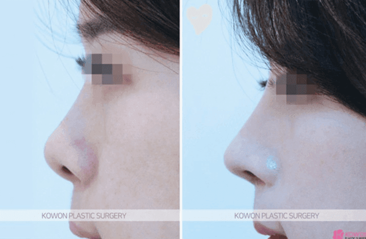 실리콘 제거하면 돼지코가 될까요? — 코 움직임이 돌아오는 시기와 기다려야 하는 이유 관련 이미지 5/10
