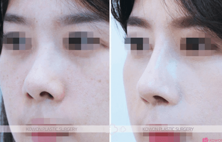 실리콘 제거하면 돼지코가 될까요? — 코 움직임이 돌아오는 시기와 기다려야 하는 이유 관련 이미지 6/10
