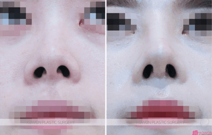 실리콘 제거하면 돼지코가 될까요? — 코 움직임이 돌아오는 시기와 기다려야 하는 이유 관련 이미지 7/10