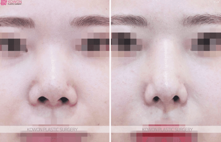 코수술 복원, 실리콘을 제거하면 원래 코로 돌아갈 수 있을까 — 되돌릴 수 있는 것과 남는 것 관련 이미지 4/9