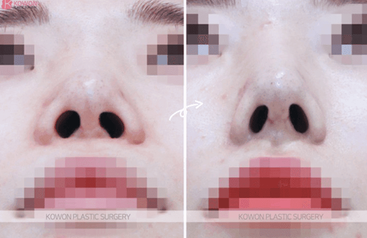 การบูรณะการผ่าตัดจมูกจมูกจะกลับคืนสู่สภาพเดิมได้หรือไม่หากเอาซิลิโคนออก? — อะไรบ้างที่สามารถแก้ไขได้ และอะไรบ้างที่ยังคงอยู่ ภาพที่เกี่ยวข้อง 6/9