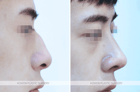 코 실리콘 제거 후 돼지코가 안 될 때 — 수술 직후 부기와 6개월 경과 기준 관련 이미지 4/5