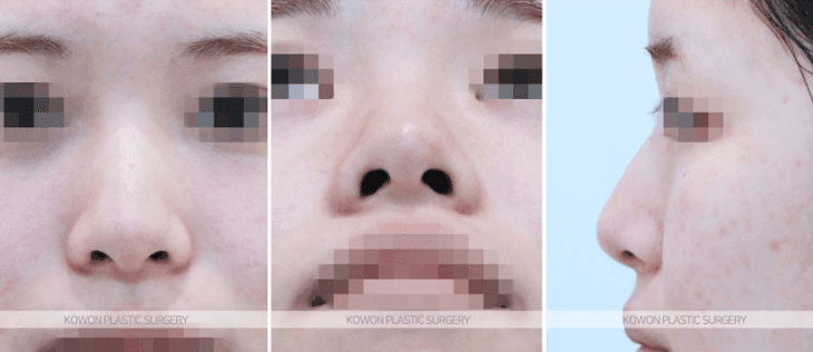 코 실리콘 제거 후 돼지코가 안 될 때 — 수술 직후 부기와 6개월 경과 기준 관련 이미지 5/5