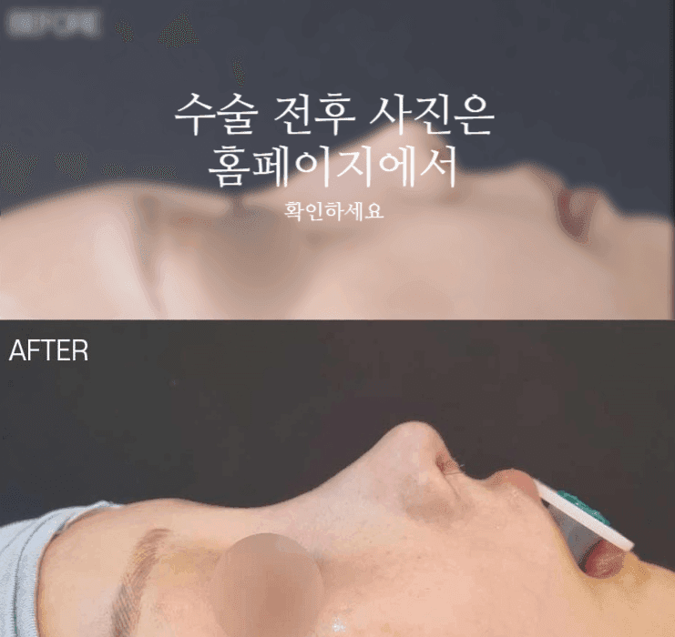 작은코성형에서 입체감을 만드는 세 가지 — 매부리·코끝 길이·전체 연결감 관련 이미지 2/11