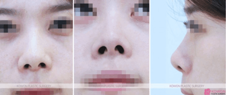 작은코성형에서 입체감을 만드는 세 가지 — 매부리·코끝 길이·전체 연결감 관련 이미지 5/11