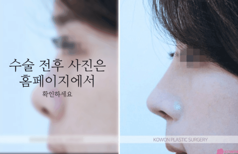 작은코성형에서 입체감을 만드는 세 가지 — 매부리·코끝 길이·전체 연결감 관련 이미지 6/11