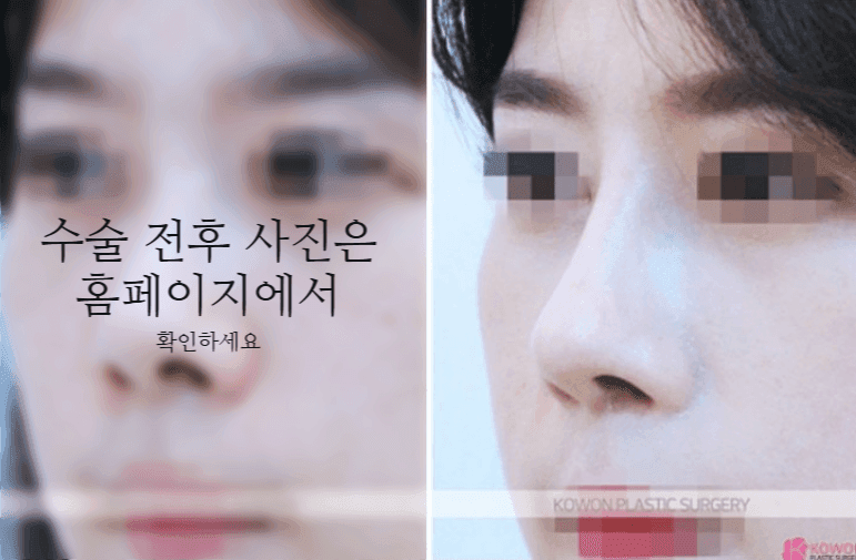 작은코성형에서 입체감을 만드는 세 가지 — 매부리·코끝 길이·전체 연결감 관련 이미지 7/11