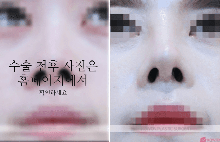 작은코성형에서 입체감을 만드는 세 가지 — 매부리·코끝 길이·전체 연결감 관련 이미지 8/11