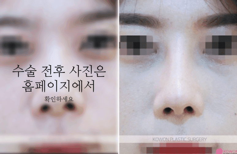작은코성형에서 입체감을 만드는 세 가지 — 매부리·코끝 길이·전체 연결감 관련 이미지 9/11
