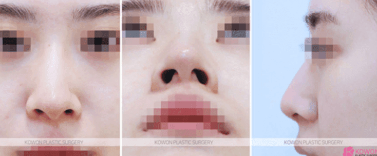 웃을 때만 코가 퍼지고 화살코가 돼요 — 근육 조절 수술이 검토되는 경우 관련 이미지 4/10