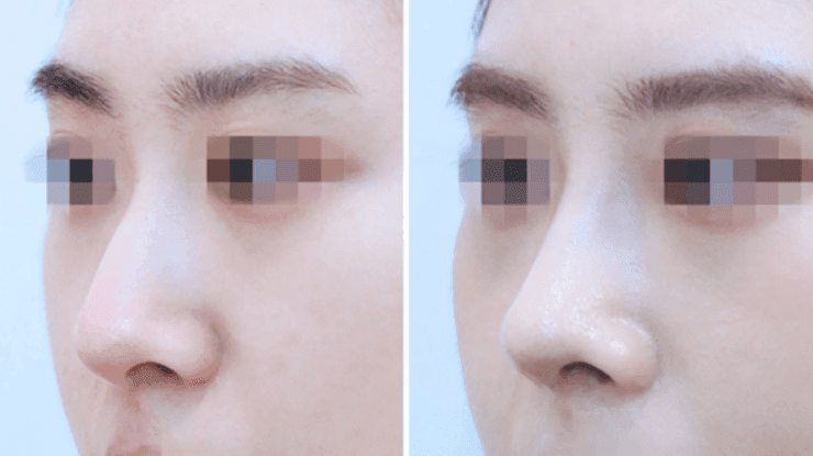 웃을 때만 코가 퍼지고 화살코가 돼요 — 근육 조절 수술이 검토되는 경우 관련 이미지 6/10