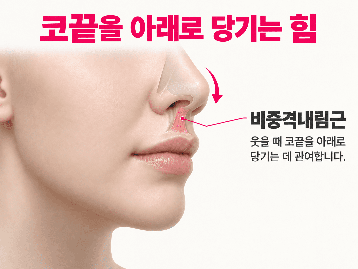 비중격내림근의 대략적인 위치와 코끝을 아래로 당기는 방향을 표시한 설명 그림