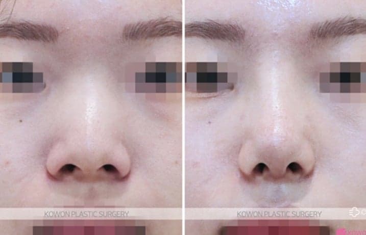 웃을 때 코끝이 처지고 콧볼이 퍼진다면 — 스마일링팁과 화살코수술·콧볼축소술의 역할 관련 이미지 8/9