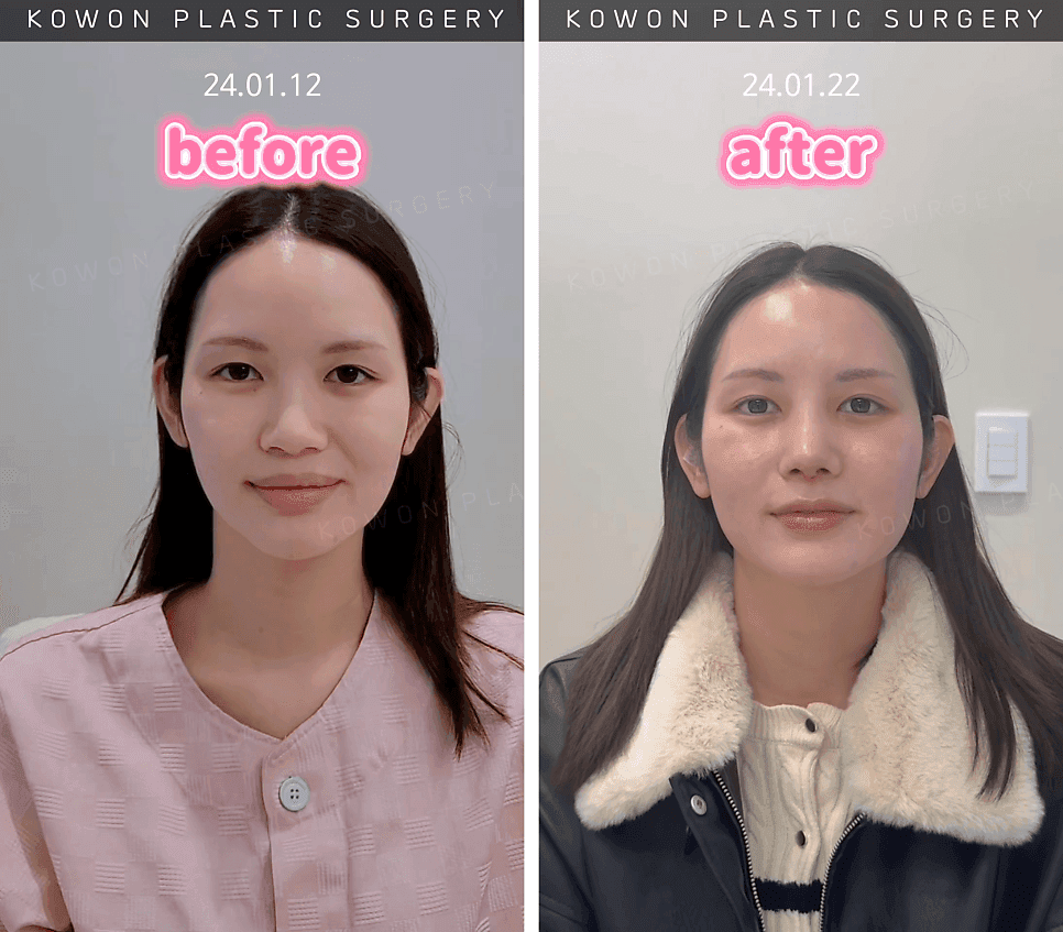 퍼진코 수술 전 확인할 것 — 콧볼만 줄이면 되지 않는 이유 관련 이미지 4/4
