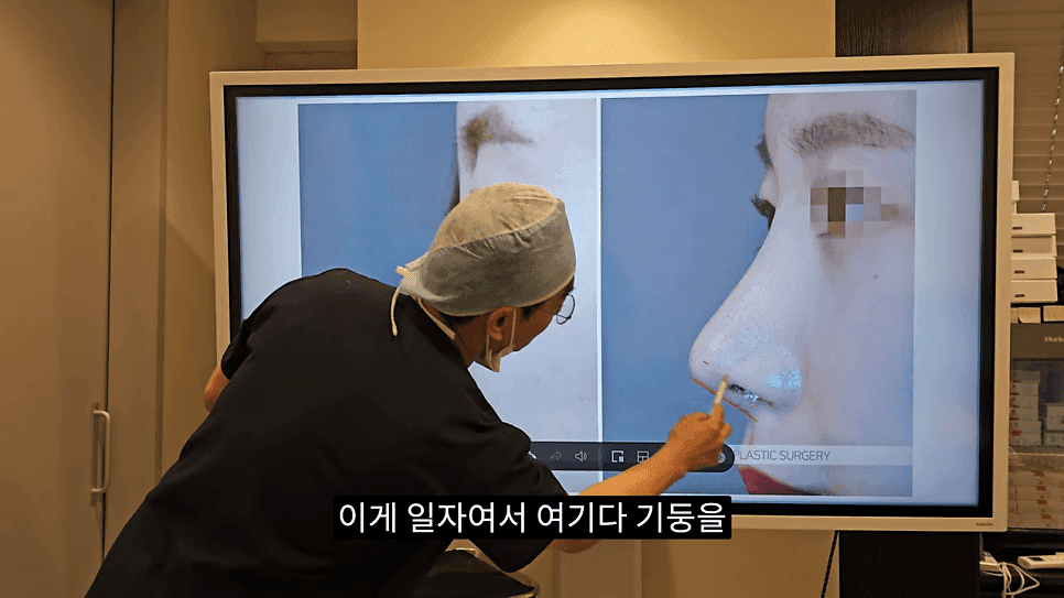 사각코성형이란 — 비주가 살짝 꺾이는 디자인이 자연스러워 보이는 이유 관련 이미지 14/25