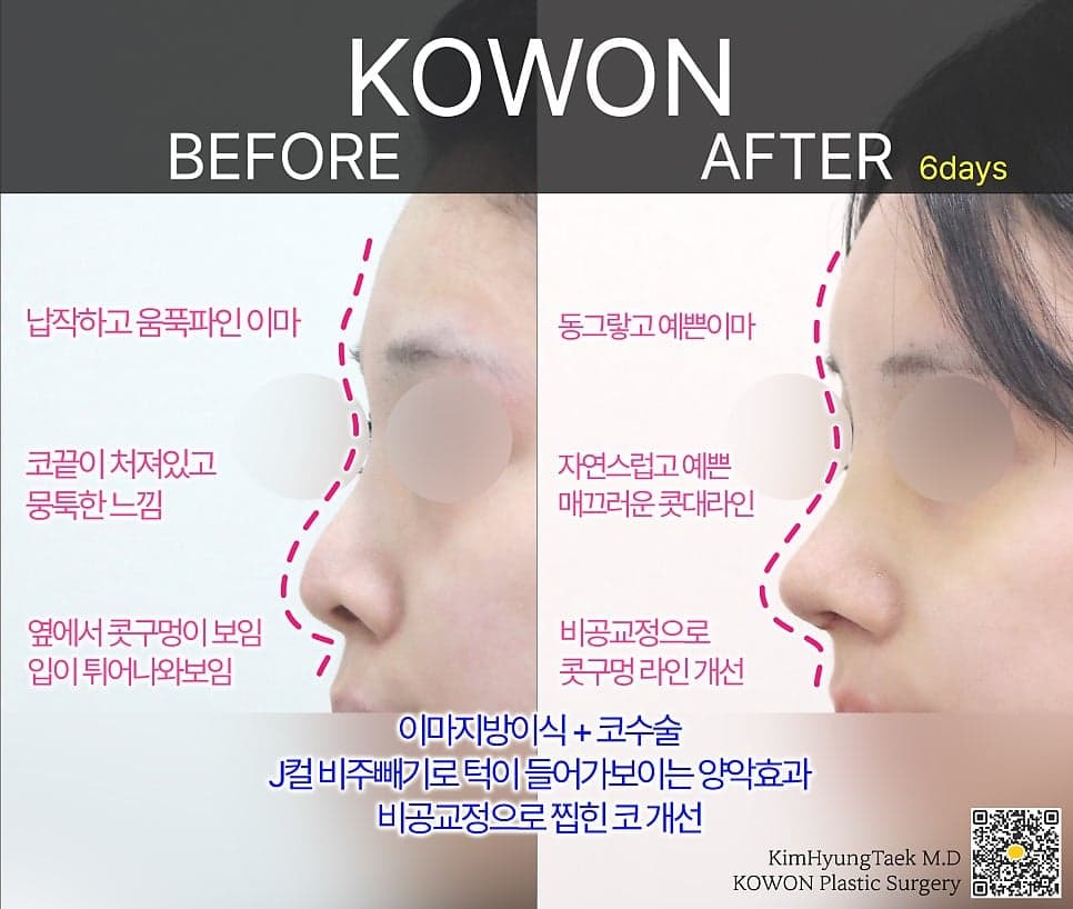 사각코성형이란 — 비주가 살짝 꺾이는 디자인이 자연스러워 보이는 이유 관련 이미지 16/25