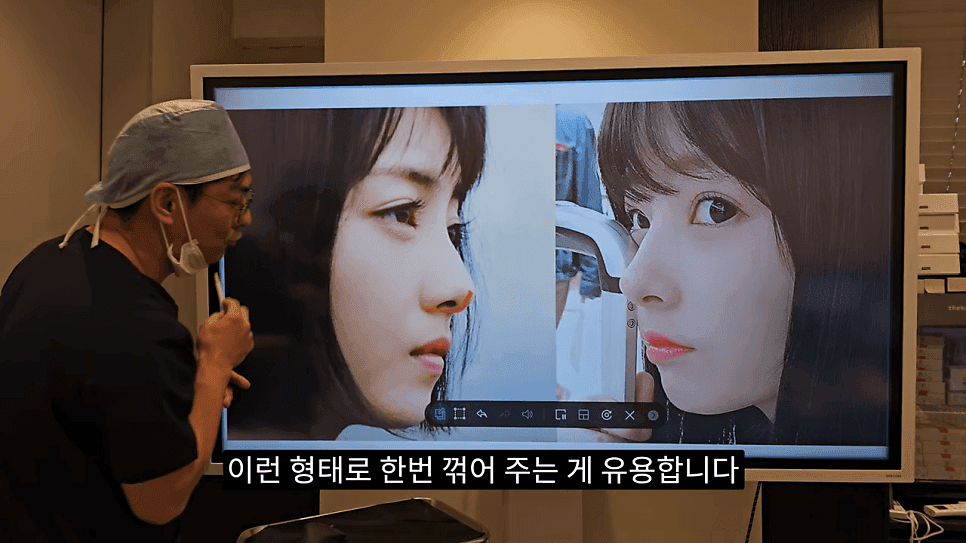 사각코성형이란 — 비주가 살짝 꺾이는 디자인이 자연스러워 보이는 이유 관련 이미지 20/25