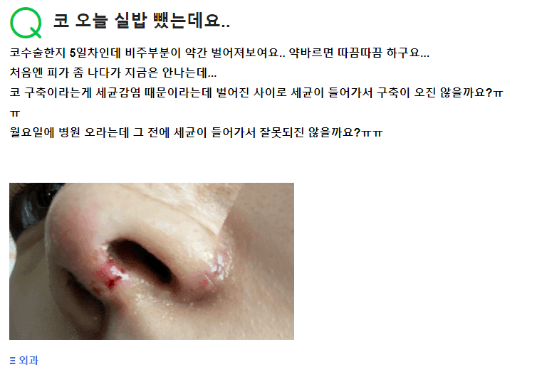 코수술 5일 뒤 실밥 제거, 비주가 벌어져 보인다면 — 구축코를 걱정하기 전에 관련 이미지 2/2