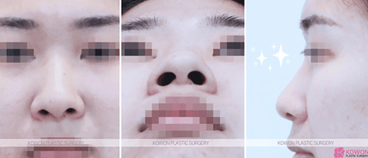 코수술 후 실밥 제거하고 통증이 심하다면 — 염증과 자극 반응을 구분하는 기준 관련 이미지 3/10