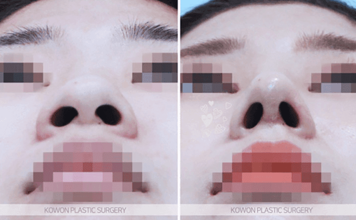 หากคุณมีอาการปวดอย่างรุนแรงหลังการถอดไหมเย็บแผลหลังการผ่าตัดจมูก— เกณฑ์ในการแยกแยะระหว่างการอักเสบและอาการระคายเคือง ภาพที่เกี่ยวข้อง 5/10