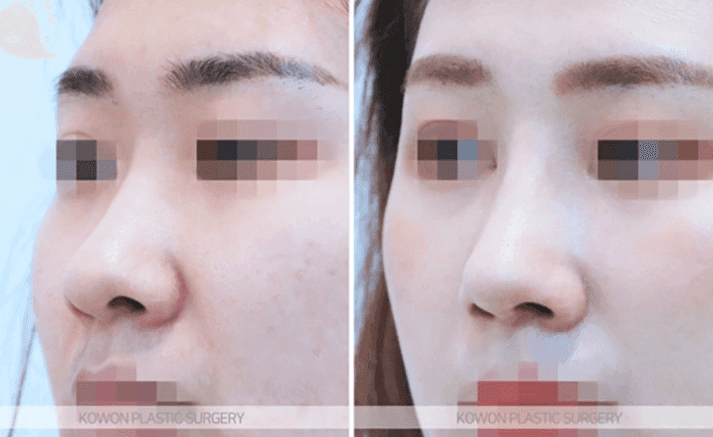 코수술 후 실밥 제거하고 통증이 심하다면 — 염증과 자극 반응을 구분하는 기준 관련 이미지 6/10