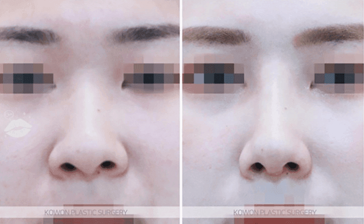 코수술 후 실밥 제거하고 통증이 심하다면 — 염증과 자극 반응을 구분하는 기준 관련 이미지 7/10