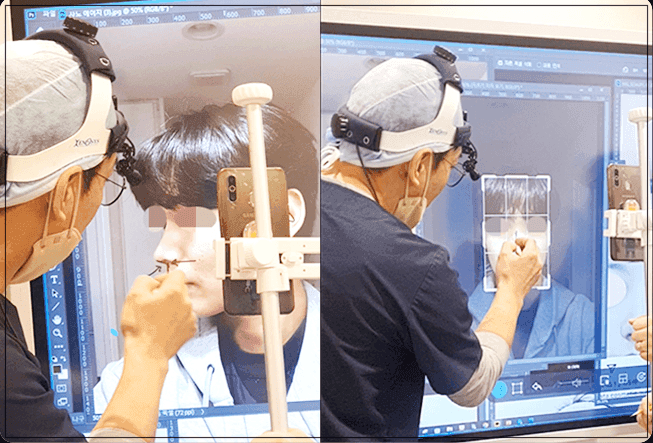 직선코 수술, 사진보다 실물이 밋밋해 보인다면 — T존과 재료를 함께 보는 이유 관련 이미지 3/9