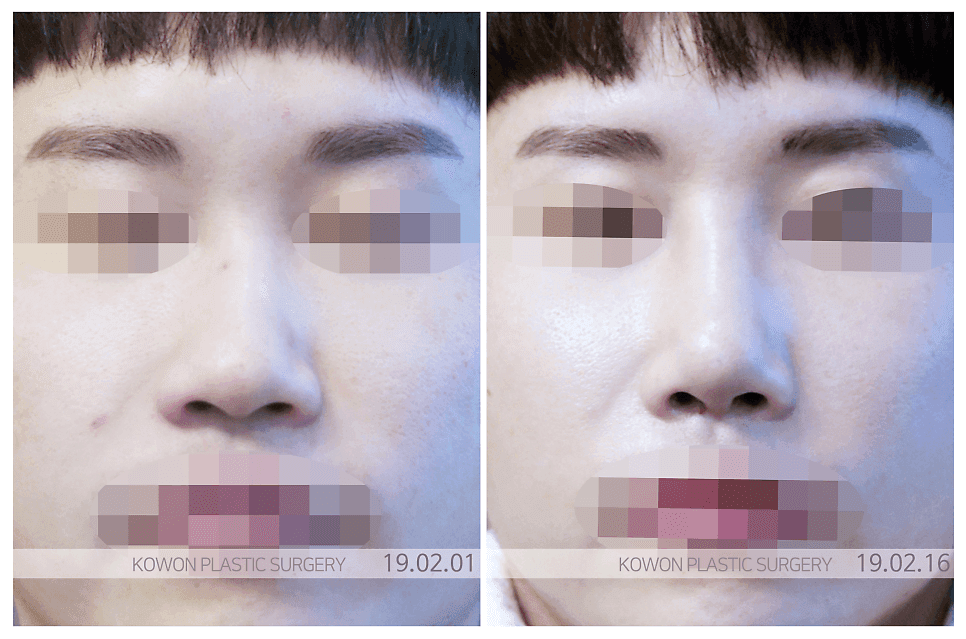 การผ่าตัดจมูกให้ตรง หากจมูกดูแบนกว่าในรูปถ่าย — เหตุใดเราจึงพิจารณาบริเวณทีโซนและวัสดุที่ใช้ร่วมกัน ภาพที่เกี่ยวข้อง 4/9