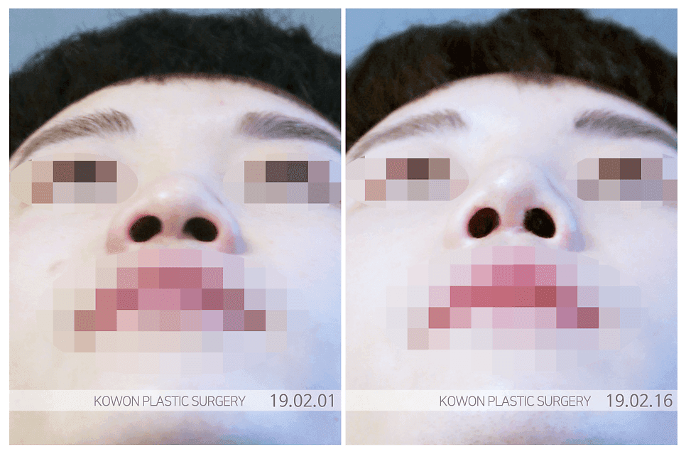 การผ่าตัดจมูกให้ตรง หากจมูกดูแบนกว่าในรูปถ่าย — เหตุใดเราจึงพิจารณาบริเวณทีโซนและวัสดุที่ใช้ร่วมกัน ภาพที่เกี่ยวข้อง 6/9