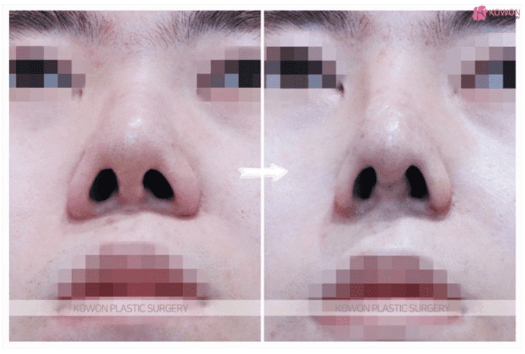 코재수술로 일자코 만들기, 코필러 병행도 가능한가요 — 지식iN 질문 5가지에 답합니다 관련 이미지 5/5