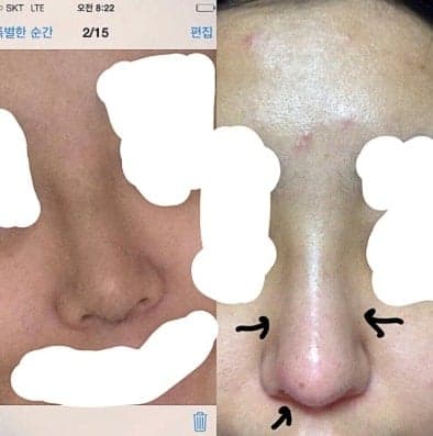 잘 빠지던 붓기가 3주째 다시 부었다면 — 콧대 부음과 코수술 염증을 확인하는 순서 관련 이미지 3/6