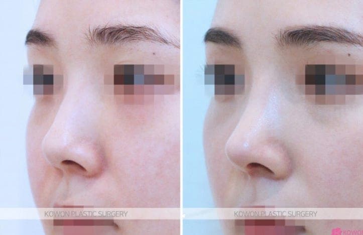 잘 빠지던 붓기가 3주째 다시 부었다면 — 콧대 부음과 코수술 염증을 확인하는 순서 관련 이미지 5/6