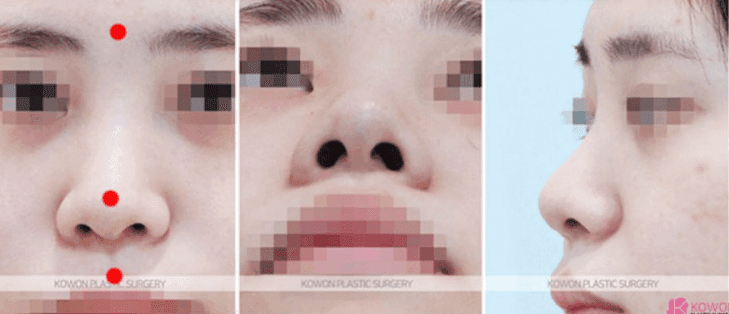 코성형 후 붓기일까 피고임일까 — 단단한 붓기와 콧대 재수술 시기 관련 이미지 3/9