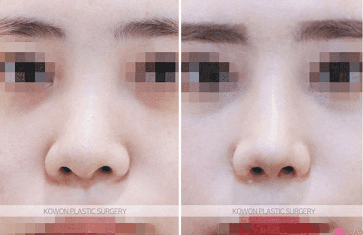 코성형 후 붓기일까 피고임일까 — 단단한 붓기와 콧대 재수술 시기 관련 이미지 6/9