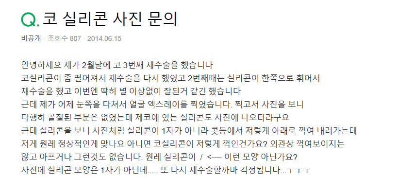세 번째 코 수술, 자가늑연골로 계획한 이유 — 기증늑연골 수술 후 재수술 사례 관련 이미지 2/10
