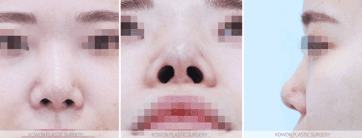 세 번째 코 수술, 자가늑연골로 계획한 이유 — 기증늑연골 수술 후 재수술 사례 관련 이미지 6/10