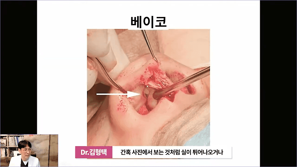 베이코 코실리프팅 후 이물질 제거, 왜 하게 될까 — 실이 문제가 되는 경우 관련 이미지 6/16
