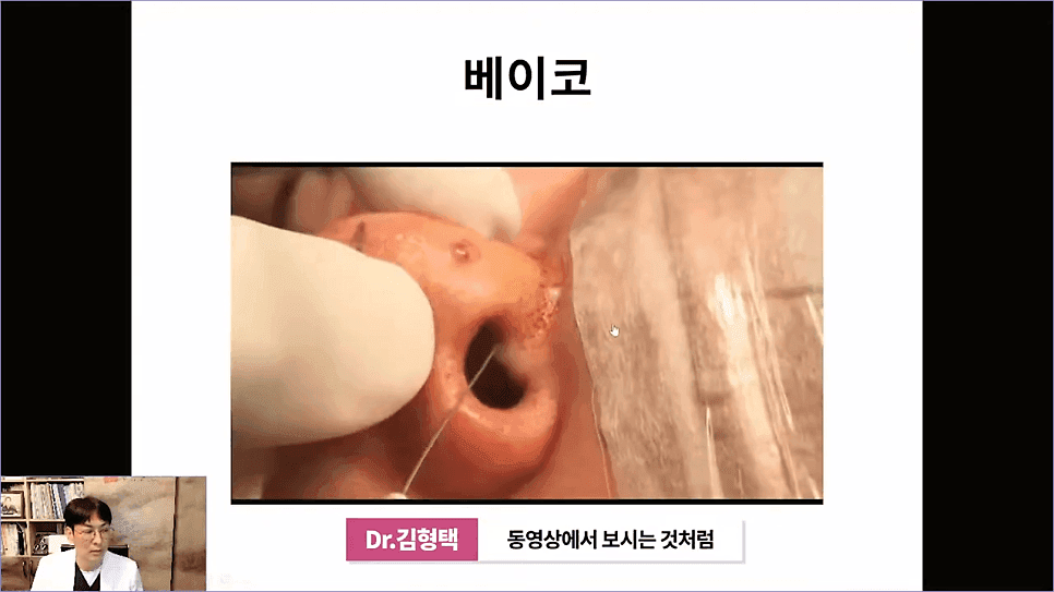 베이코 코실리프팅 후 이물질 제거, 왜 하게 될까 — 실이 문제가 되는 경우 관련 이미지 7/16
