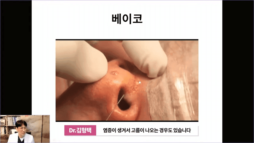 베이코 코실리프팅 후 이물질 제거, 왜 하게 될까 — 실이 문제가 되는 경우 관련 이미지 8/16