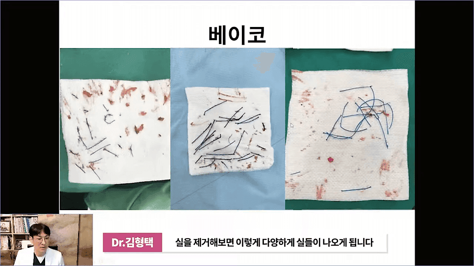 베이코 코실리프팅 후 이물질 제거, 왜 하게 될까 — 실이 문제가 되는 경우 관련 이미지 9/16